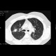 Wegener's granulomatosis, HRCT: CT - Computed tomography